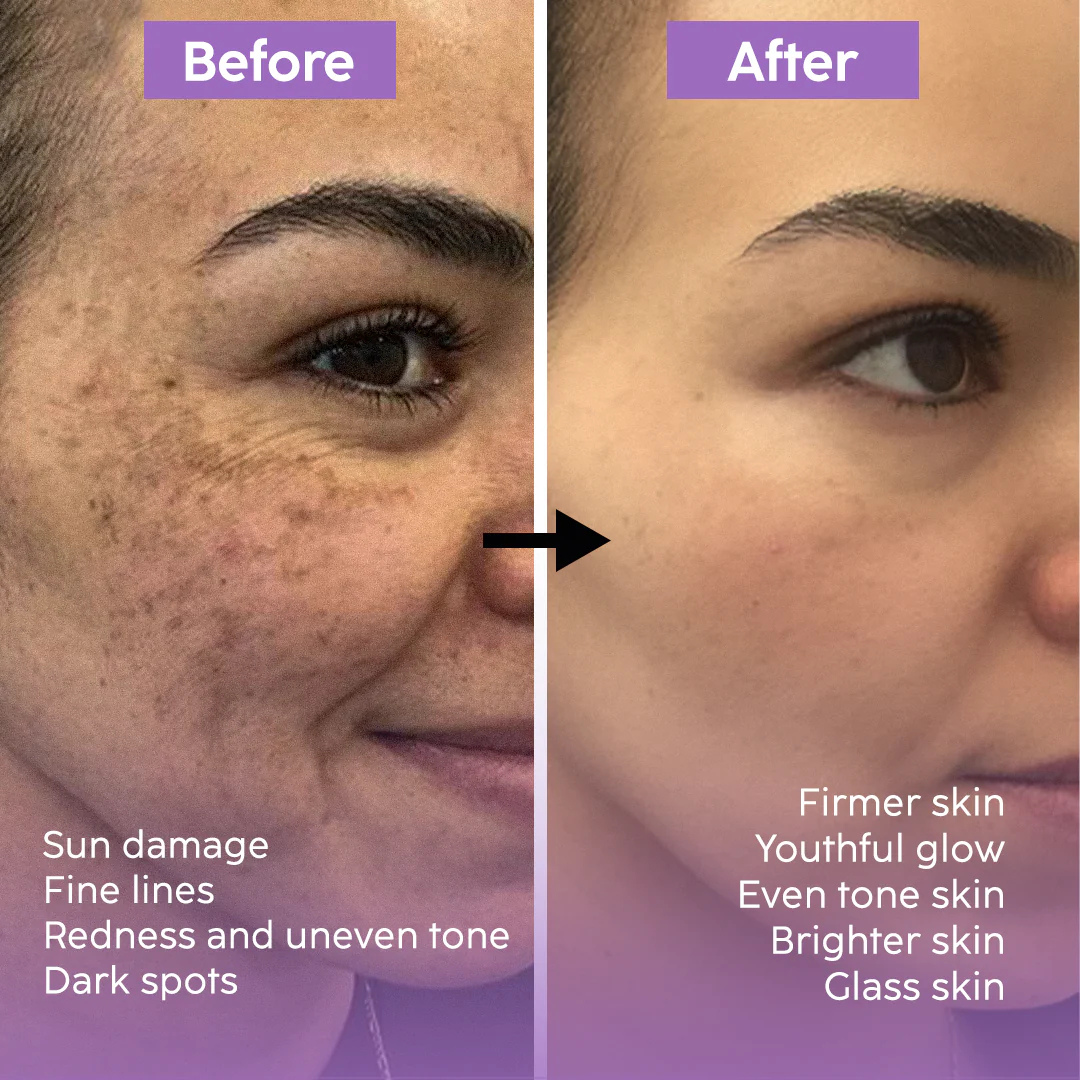 Teashell Niacinamide Brightening Serum | 5% Niacinamide + Alpha-Arbutin + Ascorbyl Acid | Fades Dark Spots, Evens Skin Tone & Boosts Glow (Buy 1 Get 1 Free)