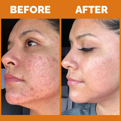 Teashell Niacinamide Brightening Serum | 5% Niacinamide + Alpha-Arbutin + Ascorbyl Acid | Fades Dark Spots, Evens Skin Tone & Boosts Glow (Buy 1 Get 1 Free)