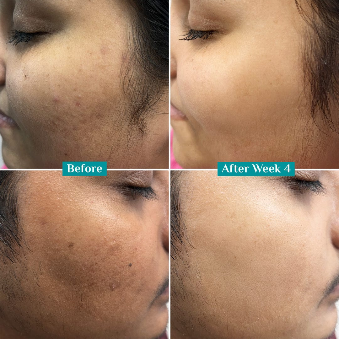 Teashell Niacinamide Brightening Serum | 5% Niacinamide + Alpha-Arbutin + Ascorbyl Acid | Fades Dark Spots, Evens Skin Tone & Boosts Glow (Buy 1 Get 1 Free)