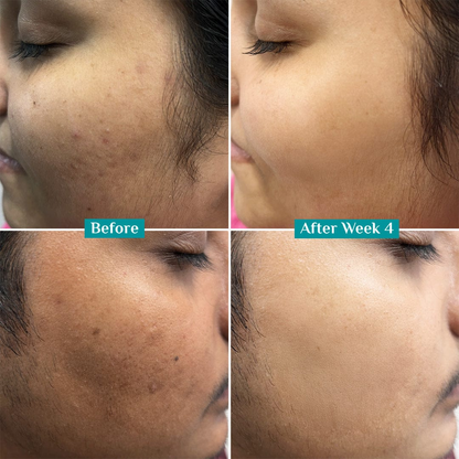 Teashell Niacinamide Brightening Serum | 5% Niacinamide + Alpha-Arbutin + Ascorbyl Acid | Fades Dark Spots, Evens Skin Tone & Boosts Glow (Buy 1 Get 1 Free)