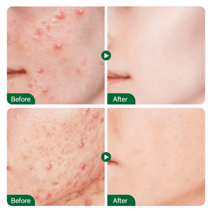 Teashell Niacinamide Brightening Serum | 5% Niacinamide + Alpha-Arbutin + Ascorbyl Acid | Fades Dark Spots, Evens Skin Tone & Boosts Glow (Buy 1 Get 1 Free)